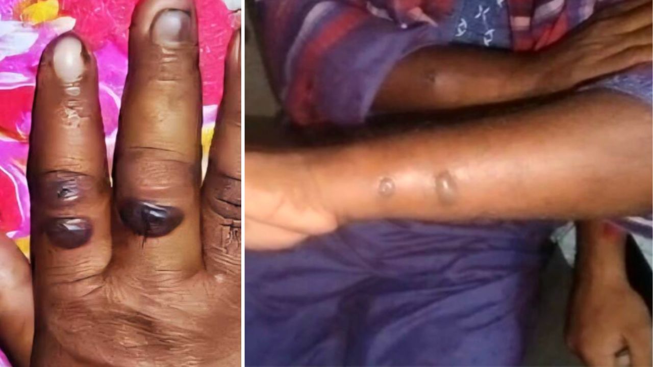 11 develop anthrax symptoms after butchering infected cow in Gaibandha