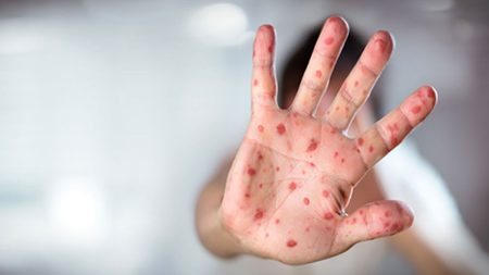 What is Measles? How and why does it spread? measles