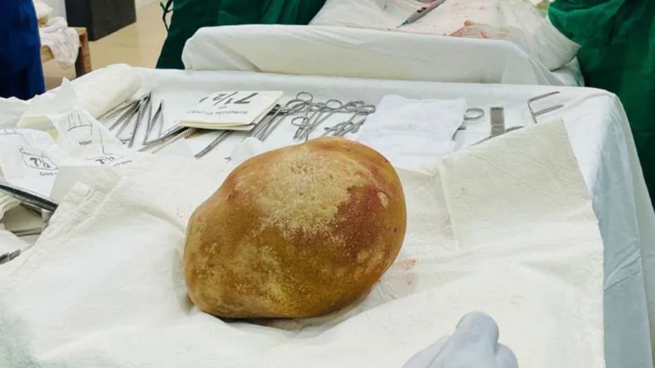 Sri Lankan surgeons extract world-record 3.1kg bladder stone