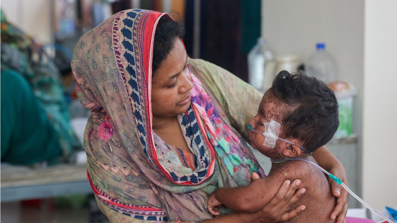 Measles