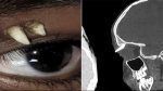 Tooth found growing inside Indian teenager’s eye socket