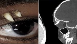 Tooth found growing inside Indian teenager’s eye socket